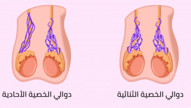 Photo of دوالي الخصية الأسباب الأعراض وطرق العلاج