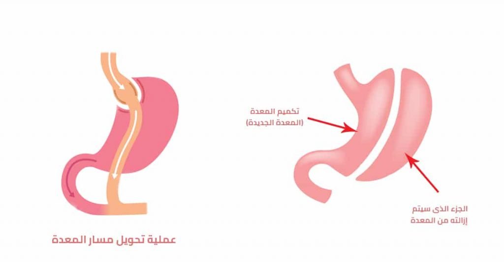 الفرق بين عملية تكميم المعدة وعملية تحوير المعدة