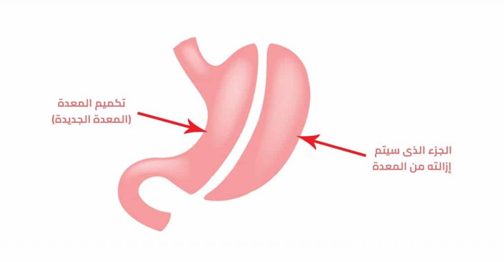 خطوات عملية تكميم المعدة بالمنظار