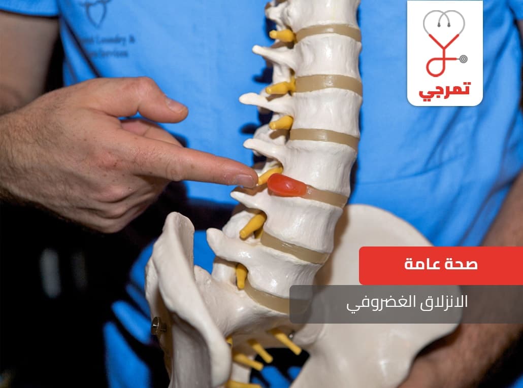 علاج الانزلاق الغضروفي