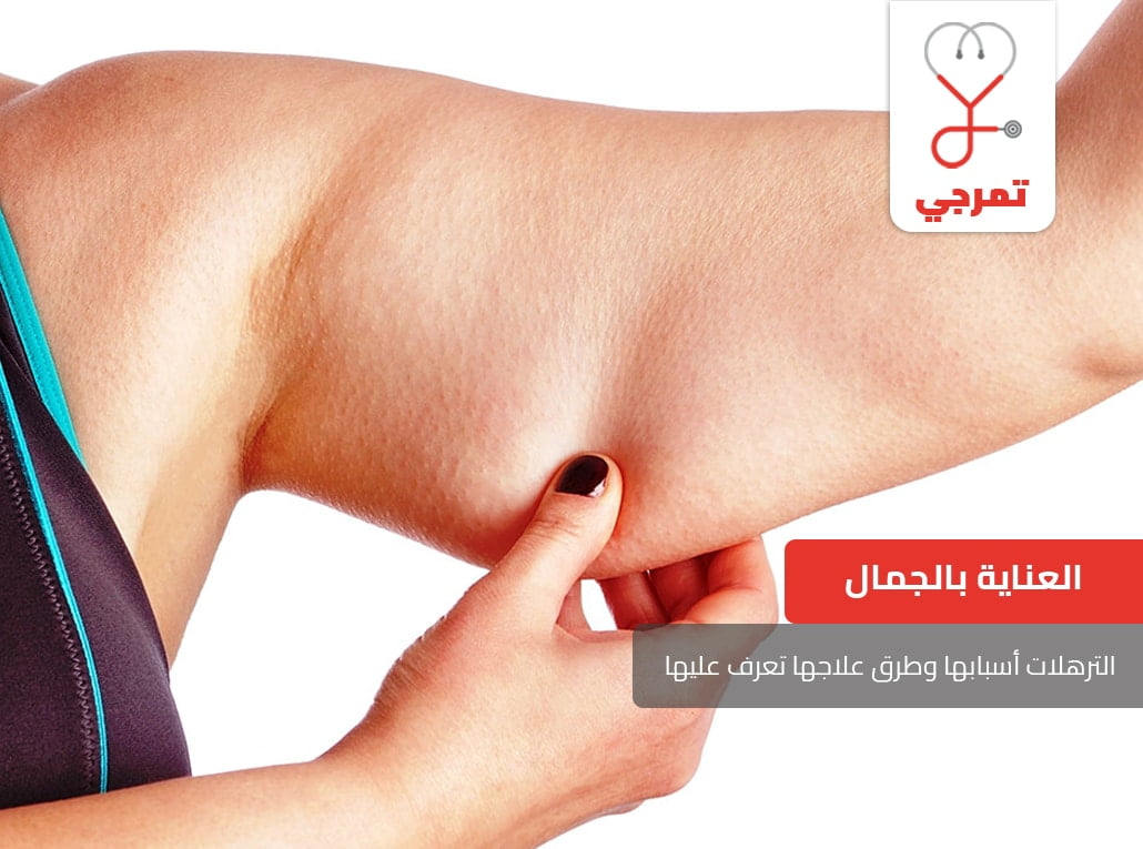 الترهلات