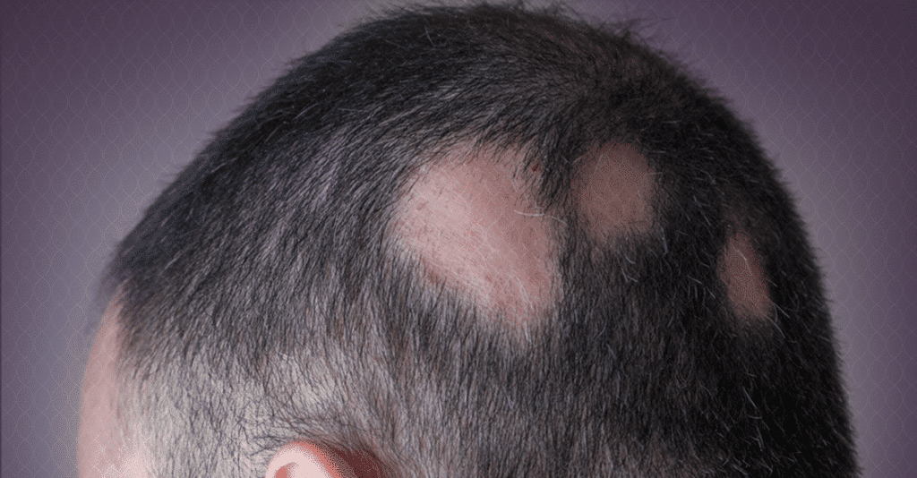 زراعة الشعر عند مرضى الثعلبة
