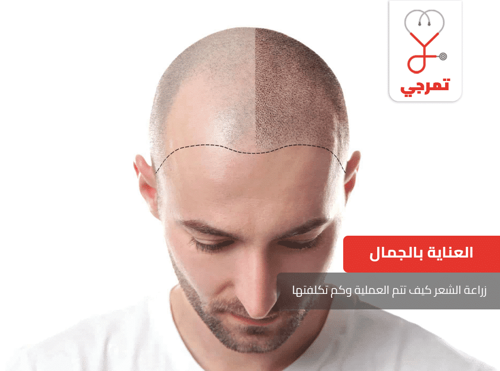 زراعة الشعر