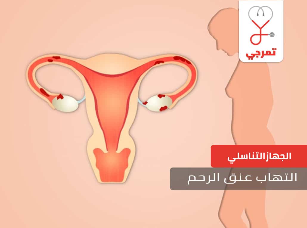 التهاب عنق الرحم