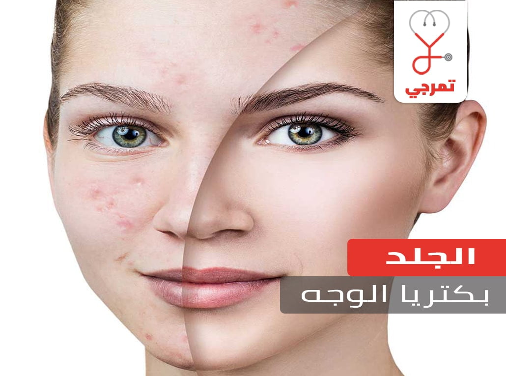 بكتيريا الوجه