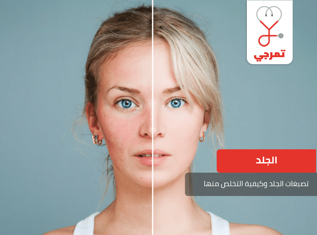 تصبغات الجلد