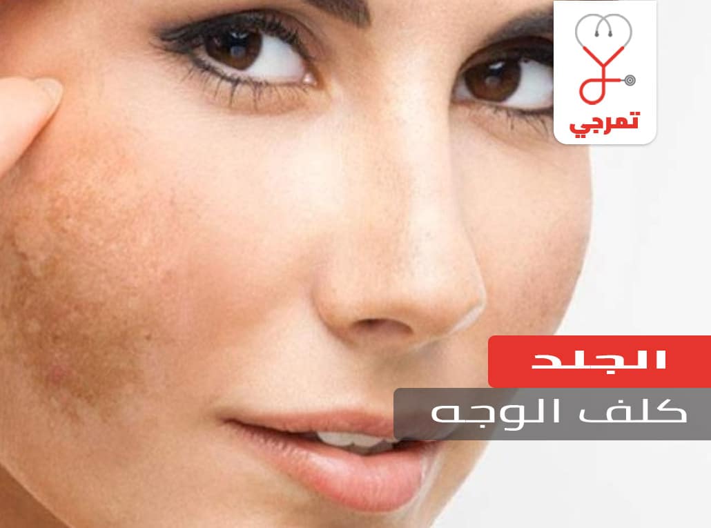 كلف الوجه