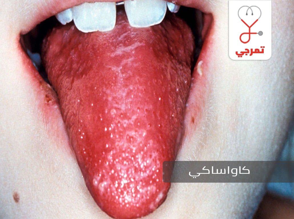 مرض كاواساكي