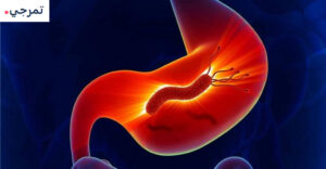 إيزوميبرازول